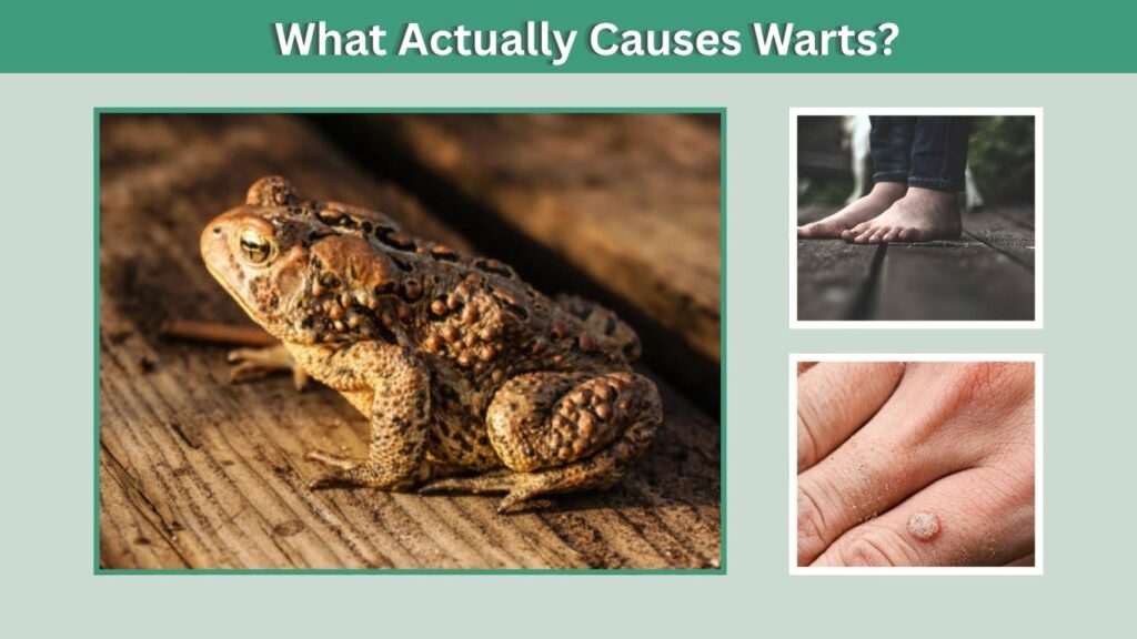 What Actually Causes Warts?